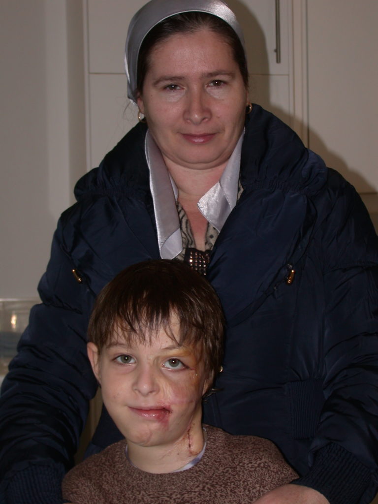 Mutter und Kind mit Brandnarbei im GEsicht - vor Operation durch Prof. Dr. Frank Peter, placet e.V.
